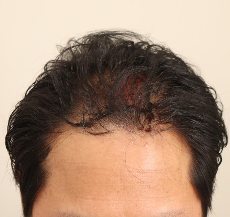 2. 수술후_1일_1.JPG