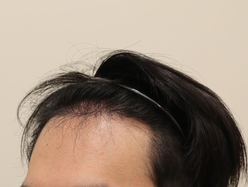 2. 수술후_6개월_2.JPG
