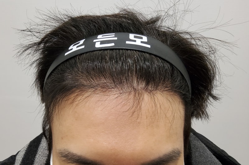 3. 수술후_6개월_1.jpg