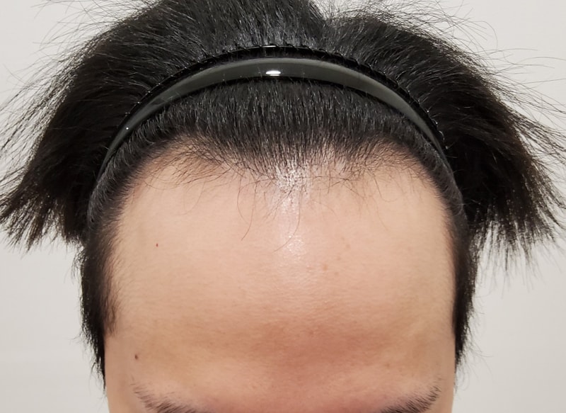 한국 들어와서 모발이식 받았습니다!