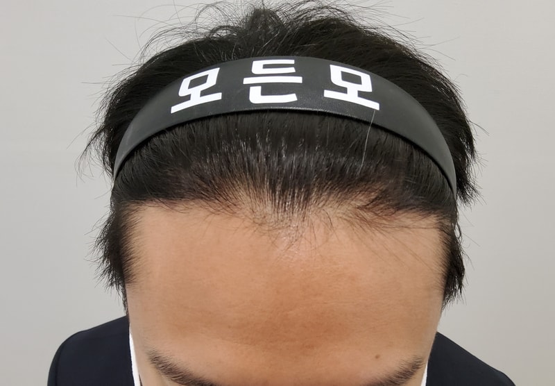2. 수술후_6개월.jpg