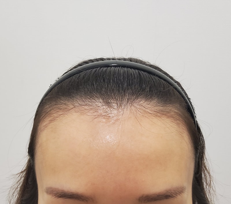 산후 탈모때문에 모발이식 했네요~