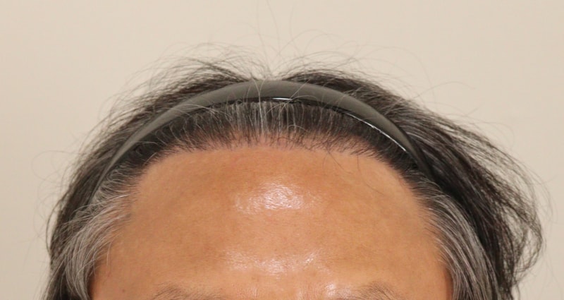 4. 수술후_6개월_1.JPG