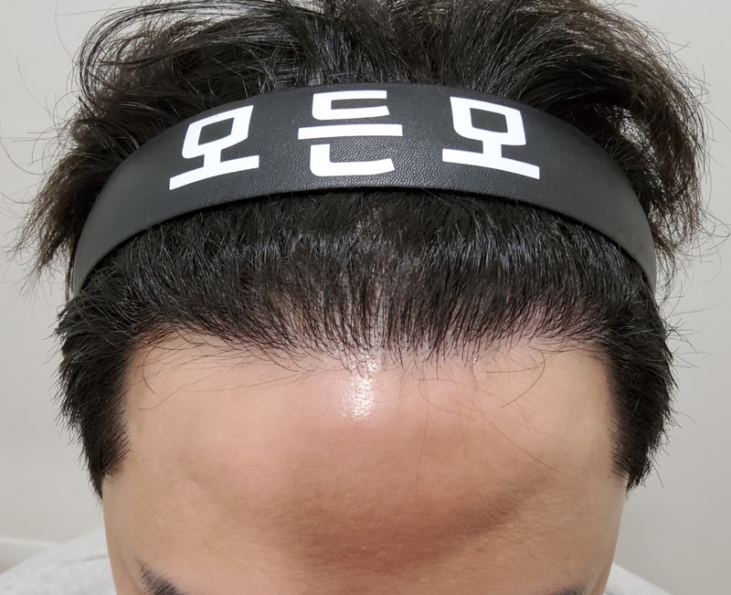 4. 수술후_1년_1.jpg