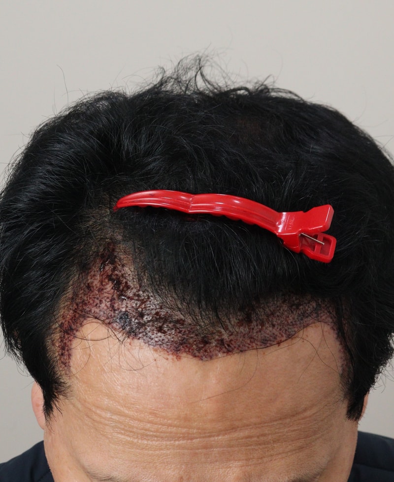 2. 수술후_1일_2.JPG