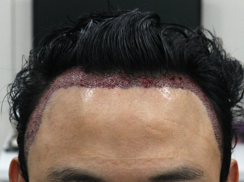 2. 수술후_당일_1.JPG