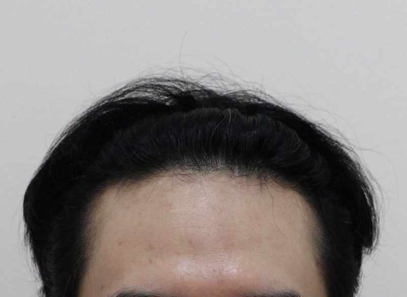 빈 부위 채우기 위해 모발이식 결정!