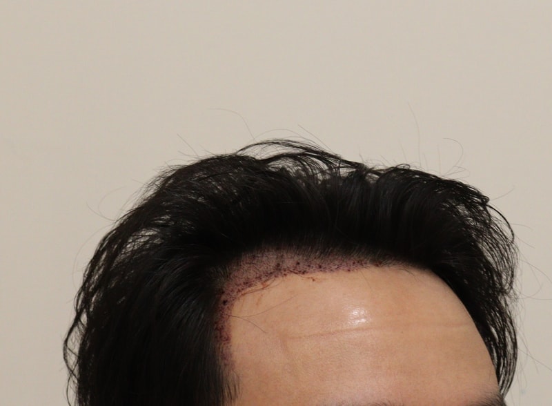 1. 수술후_1일_2.JPG
