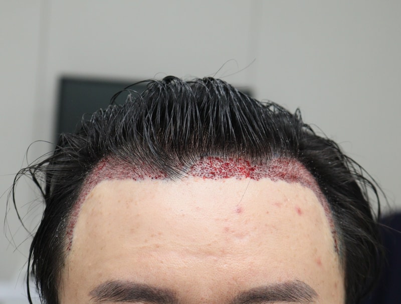 2. 수술후_당일_1.JPG