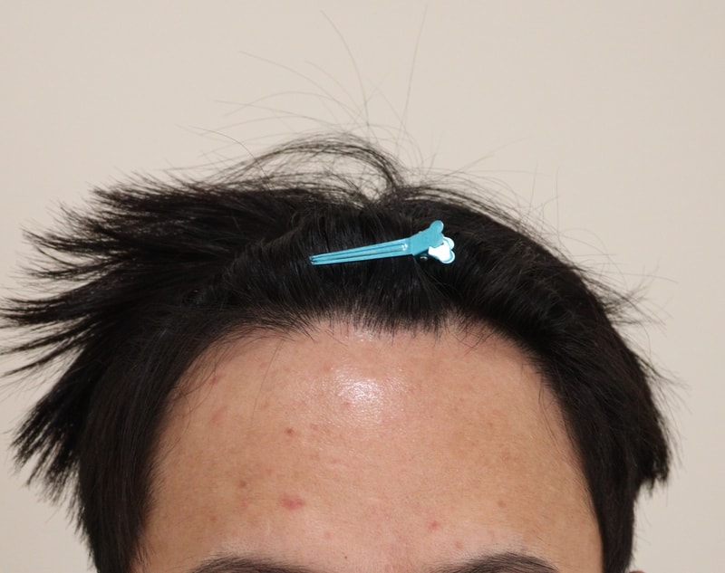 I got a 3,800-mo transplant for a non-intersected hair transplant