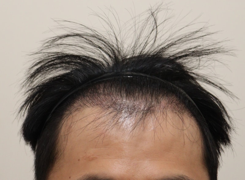 3. 수술후_3개월_1.JPG