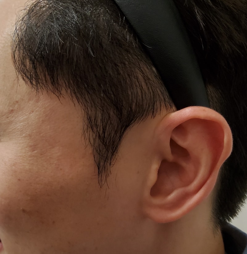 4. 수술후_1년_3.jpg