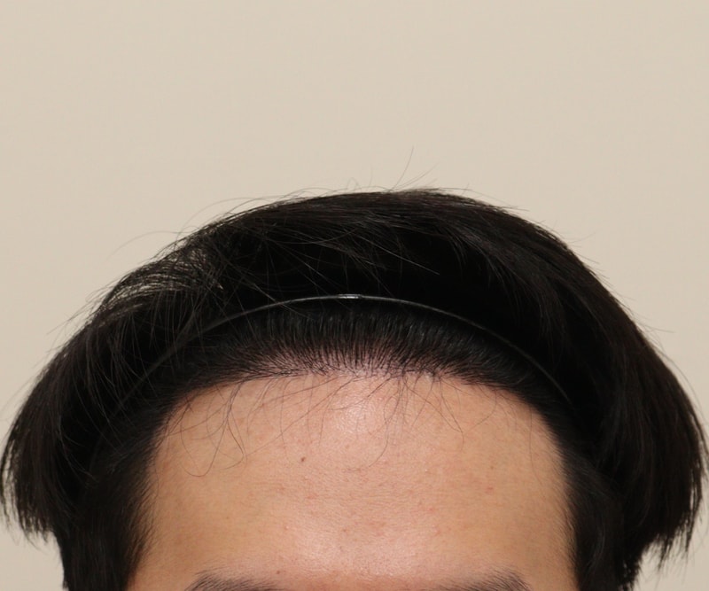 2. 수술후_6개월_1.JPG
