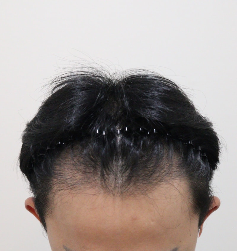 0. 수술전_2.JPG