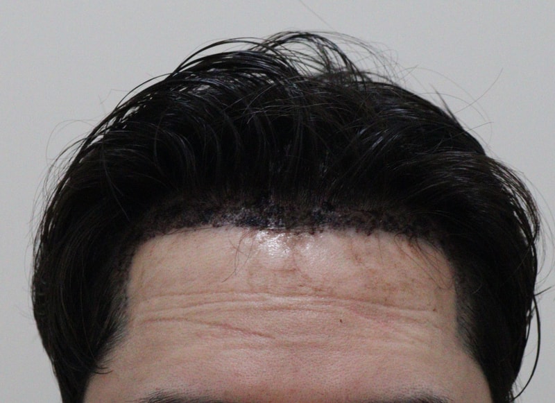 2. 수술후_1일_1.JPG
