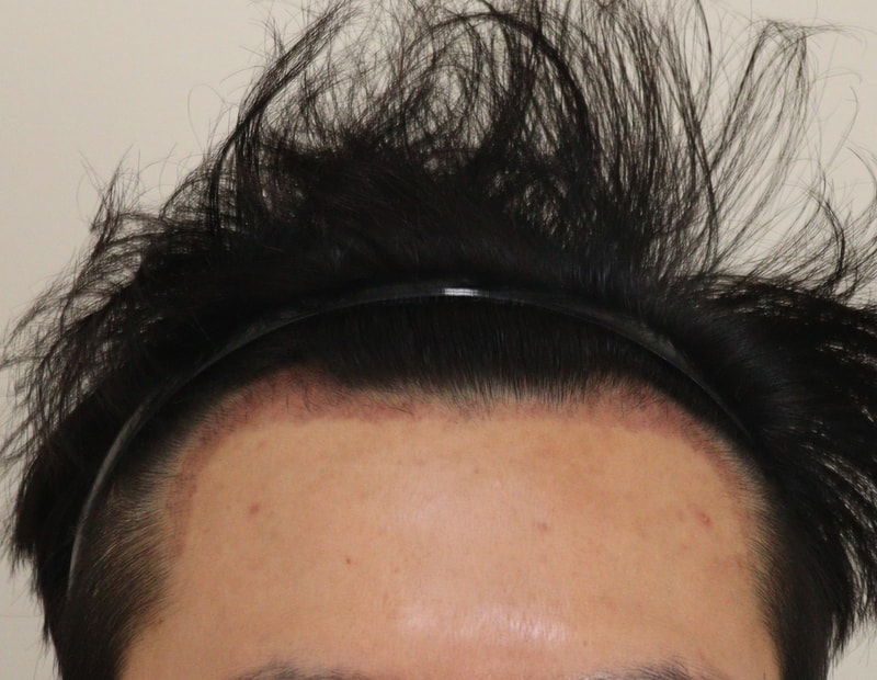 3. 수술후_1개월_1.JPG