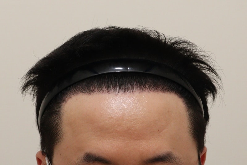 4. 수술후_7개월_1.JPG