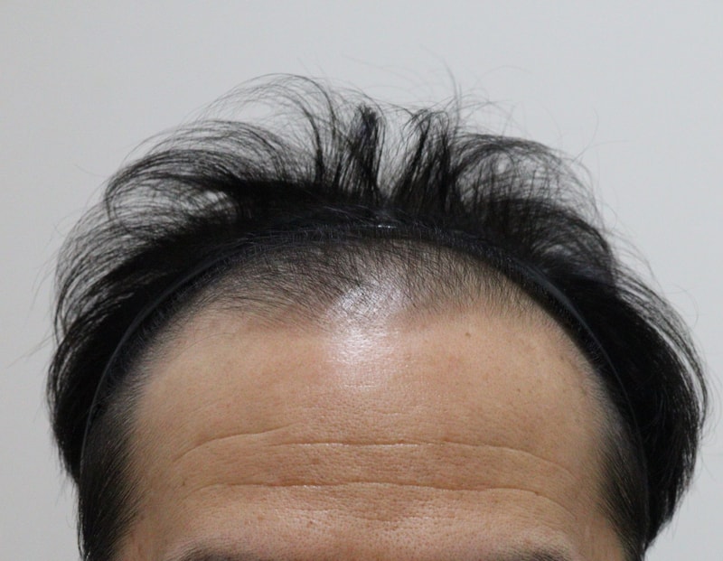 비절개 모발이식 수술 1년차가 되었습니다