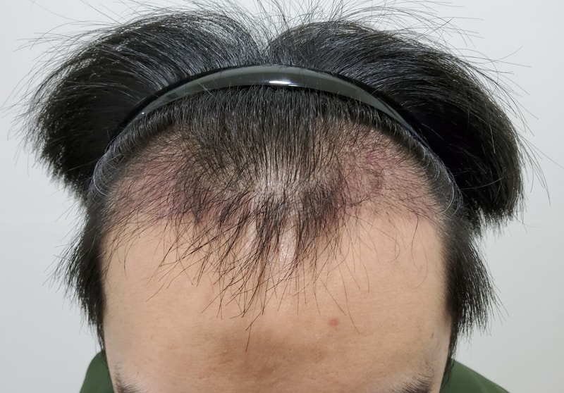 3. 수술후_3개월_1.jpg