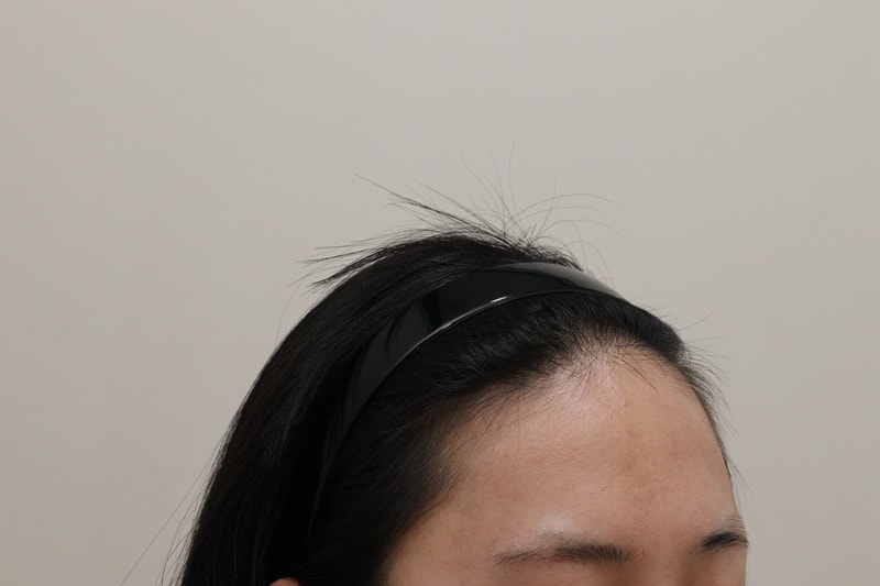 1. 수술전_3.JPG