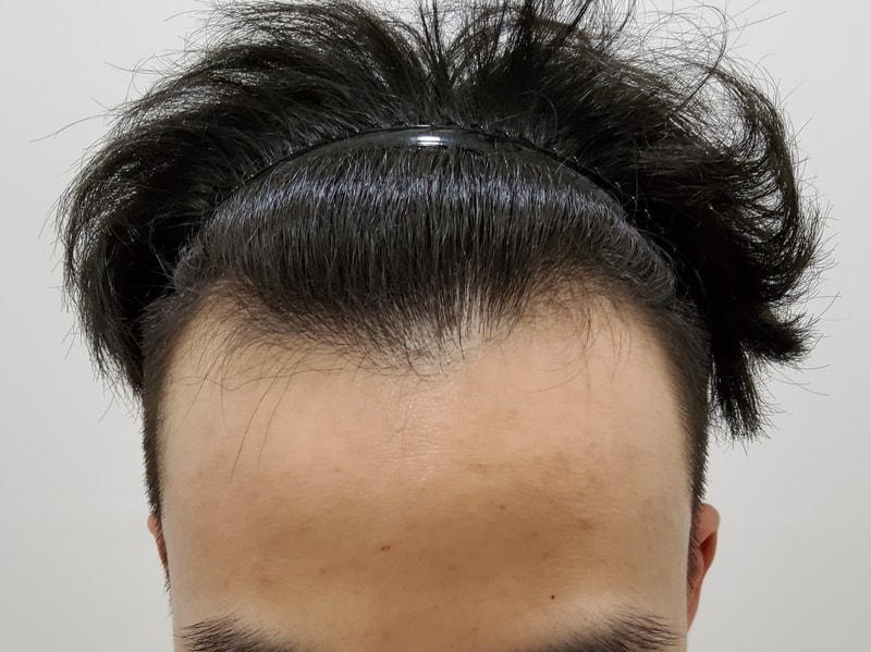 모발이식 하자마자 후기쓰로 왔습니다~