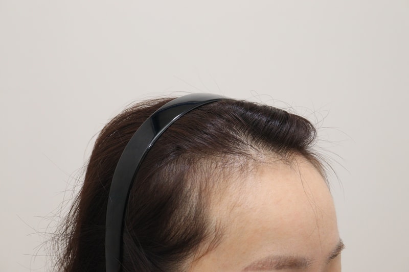 1. 수술전_3.JPG