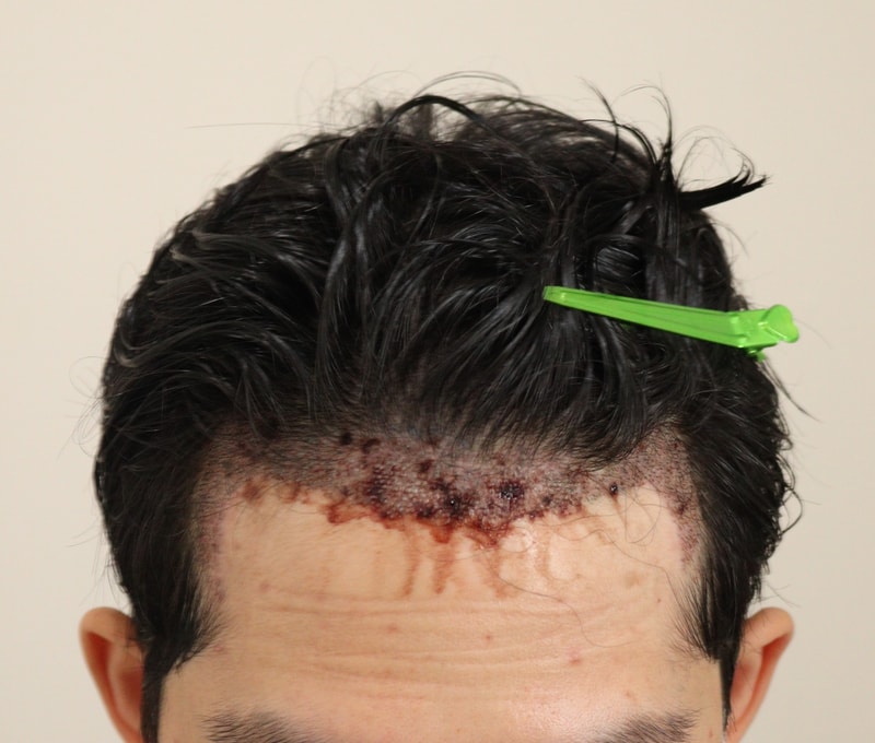 2. 수술후_1일_1.JPG