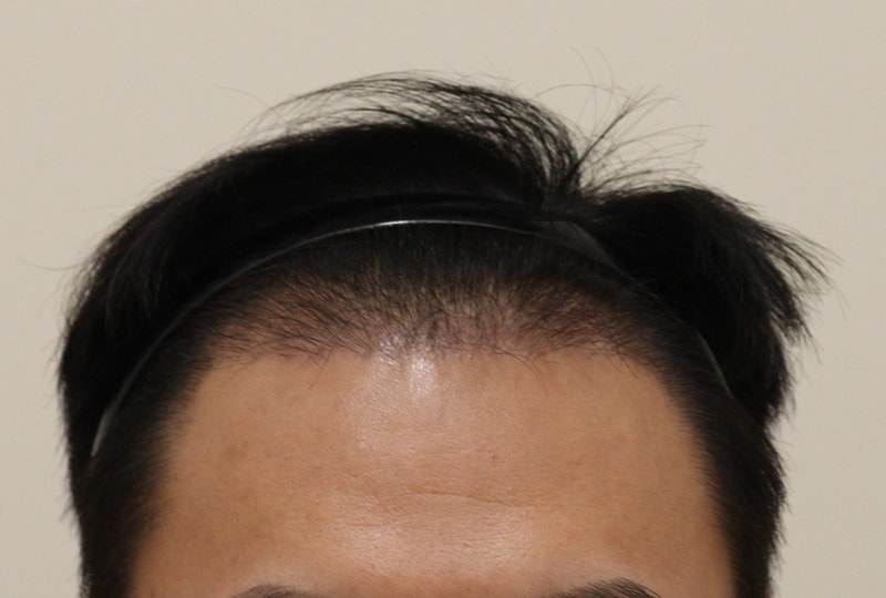 2. 수술후_3개월_1.JPG