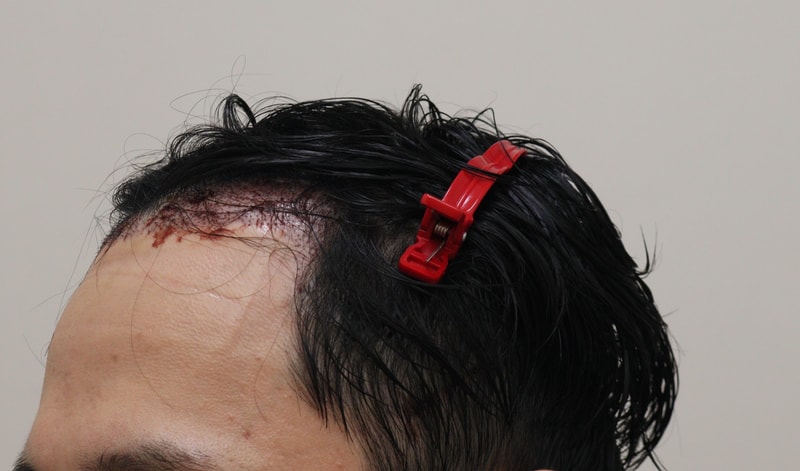 2. 수술후_1일_2.JPG