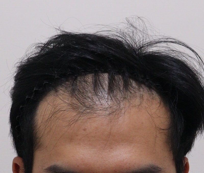 1. 수술전_1.JPG