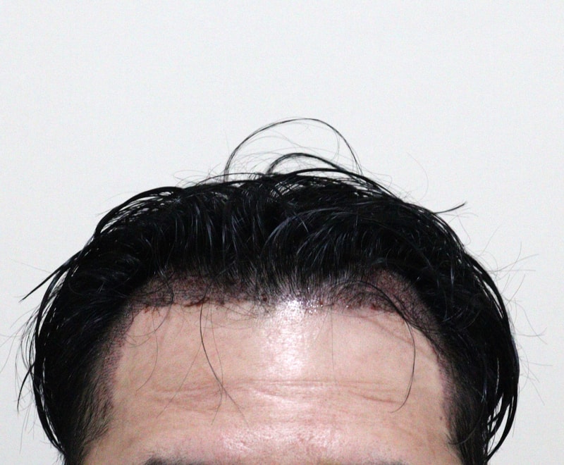 2. 수술후_1일.JPG
