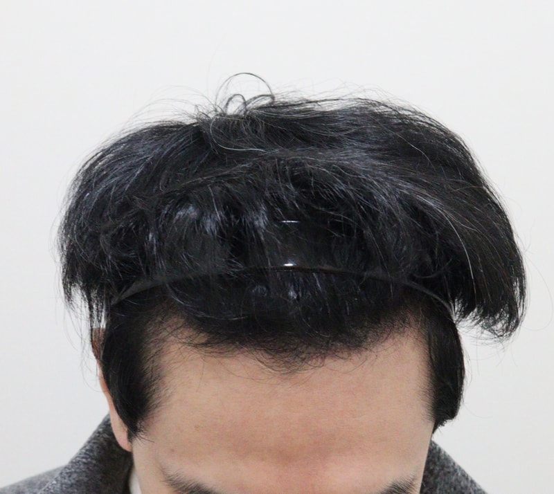3. 수술후_3개월_2.JPG