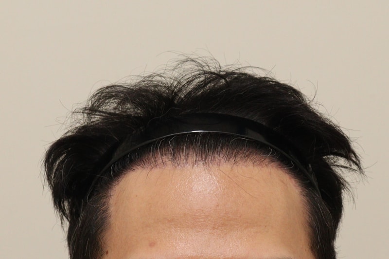 4. 수술후_6개월_1.jpg
