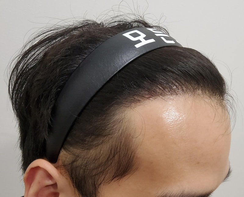 5. 수술후_1년_2.jpg