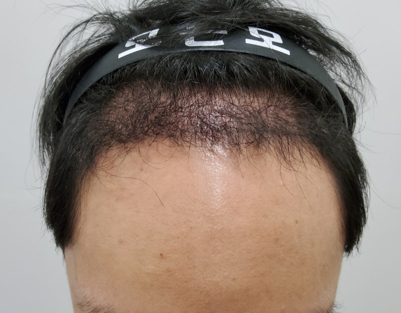 3. 수술후_3개월.jpg