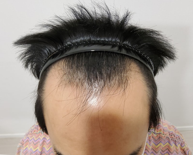 모발이식 너무 궁금했었는데 이제야 직접 느껴봅니다.