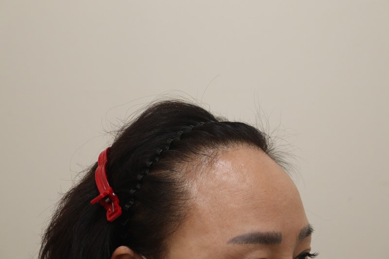 1. 수술전_3.JPG