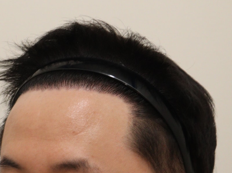 4. 수술후_7개월_3.JPG