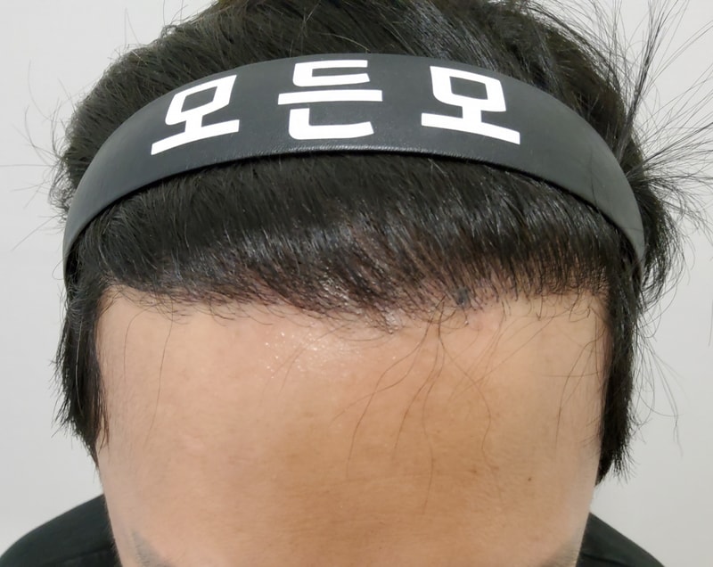 4. 수술후_6개월_1.jpg