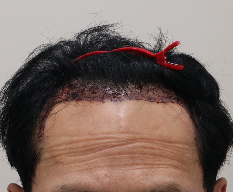2. 수술후_1일_1.JPG