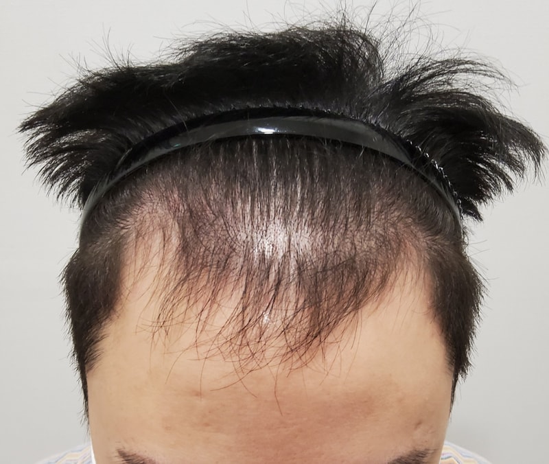 It's the third month of a 4,500 hair transplant.