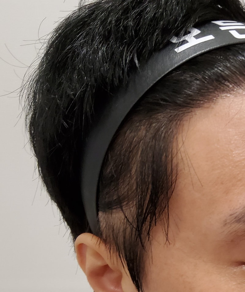 4. 수술후_1년_3.jpg