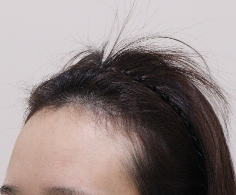 1. 수술전_2.JPG