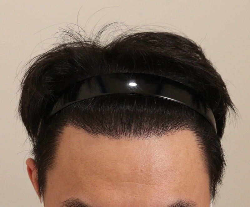 4. 수술후_1년_1.JPG