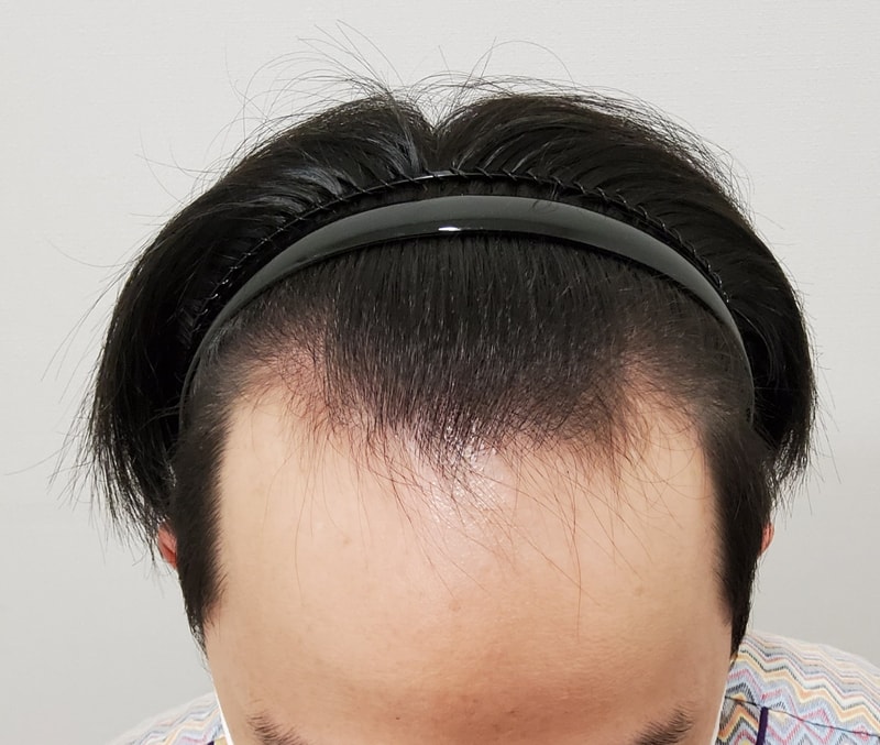 거즘 1년 되갑니다 전후차이 대박입니다