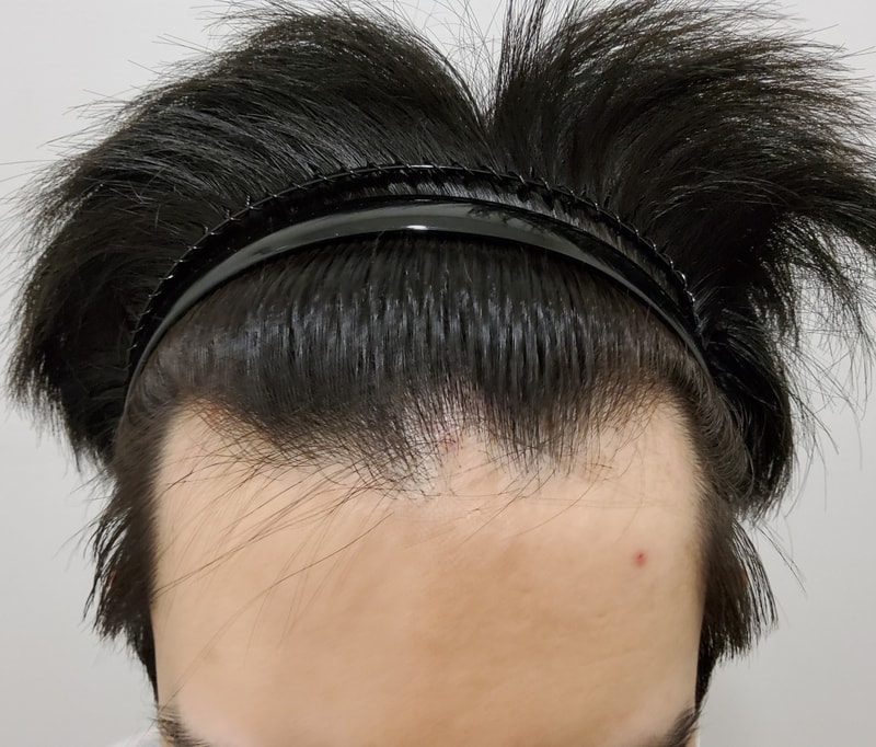 모발이식한지 벌써 6개월차 되었습니다~