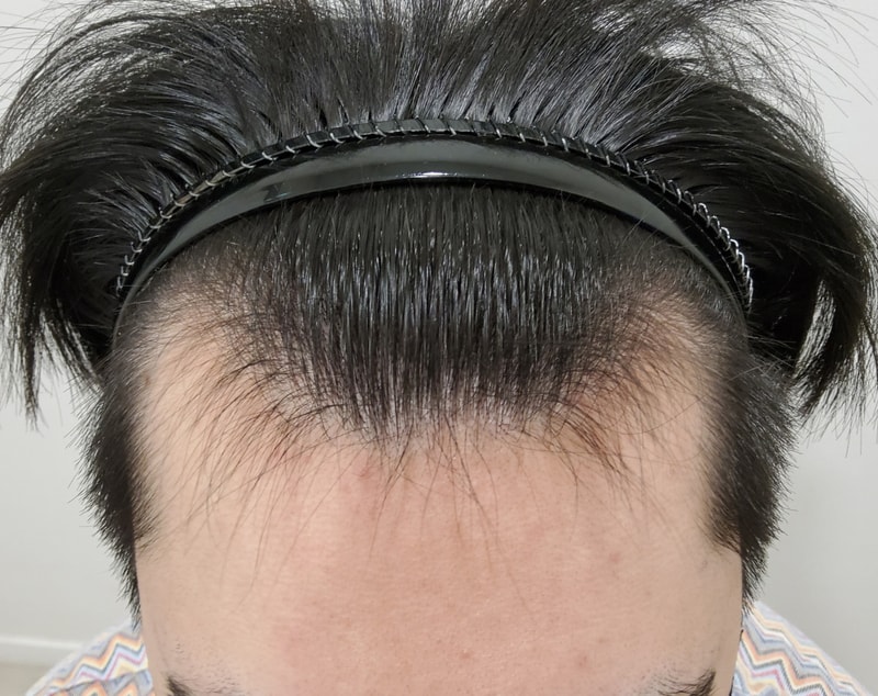 비절개 모발이식 6개월 경과 공유하겠습니다~~