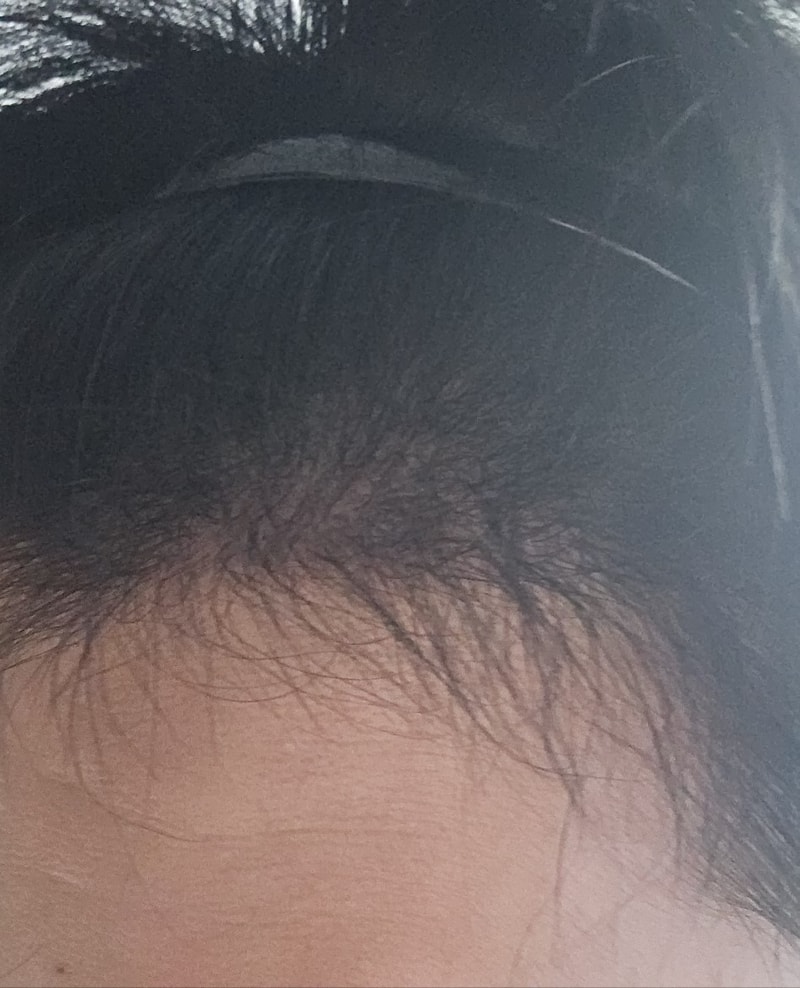 4. 수술후_6개월_셀카_2.jpg