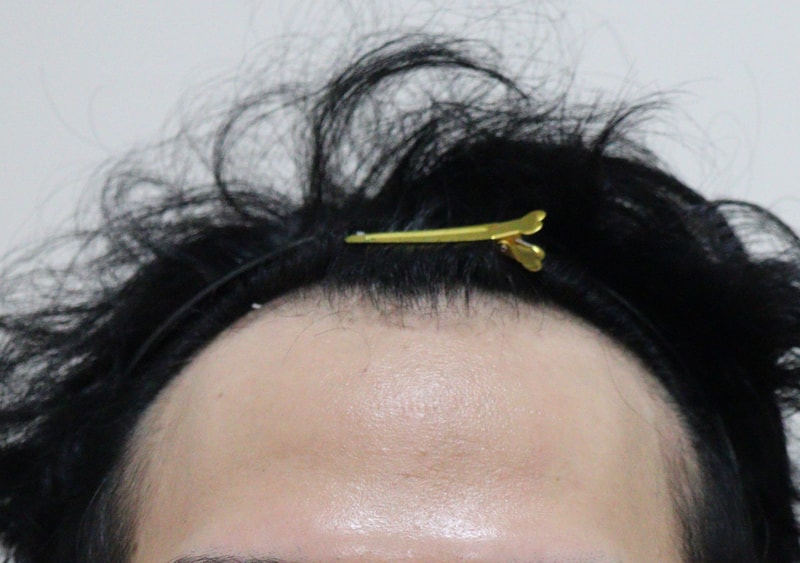 비절개 모발이식 6개월차 후기 남깁니다!