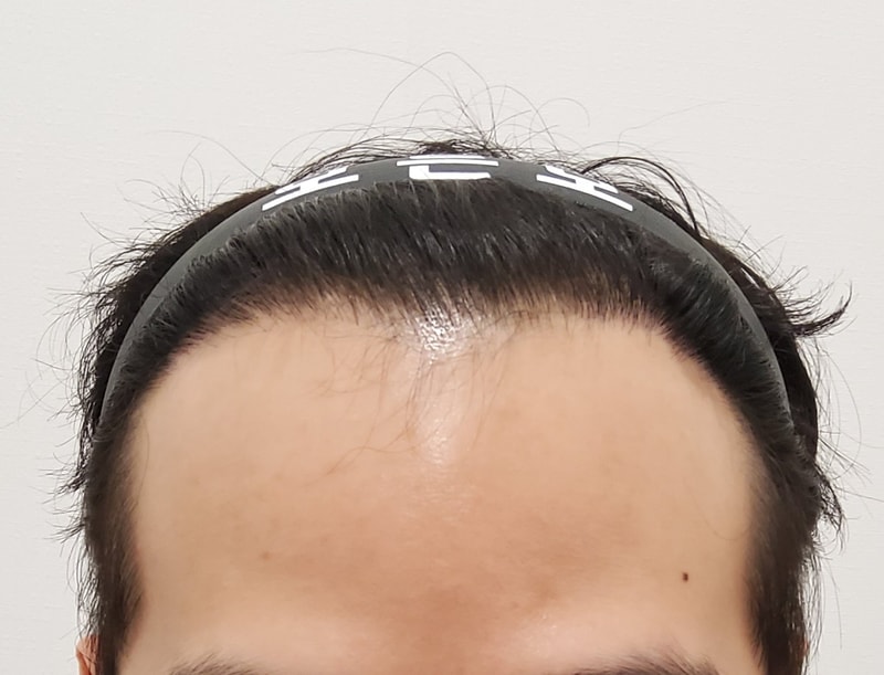 5. 수술후_1년_1.jpg